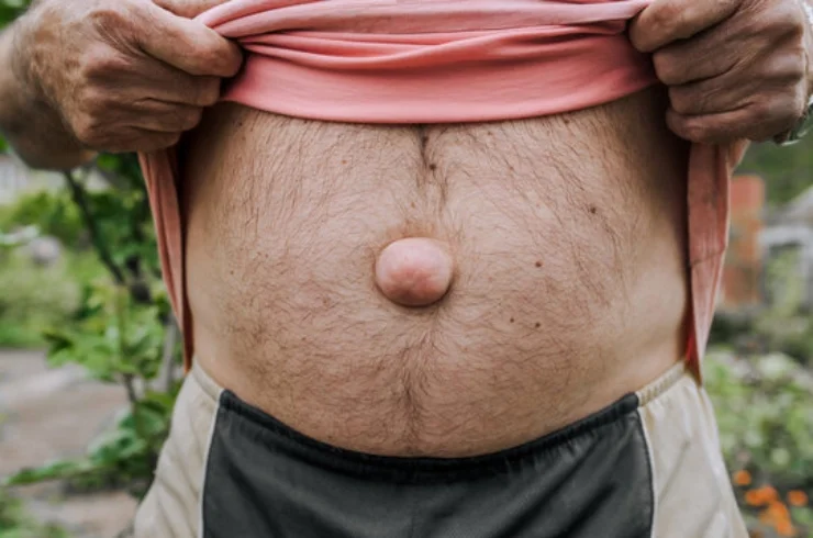 Non-Surgical Hernia Management