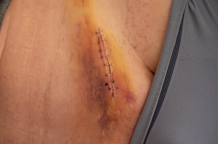Recurrent-Hernia-Repair